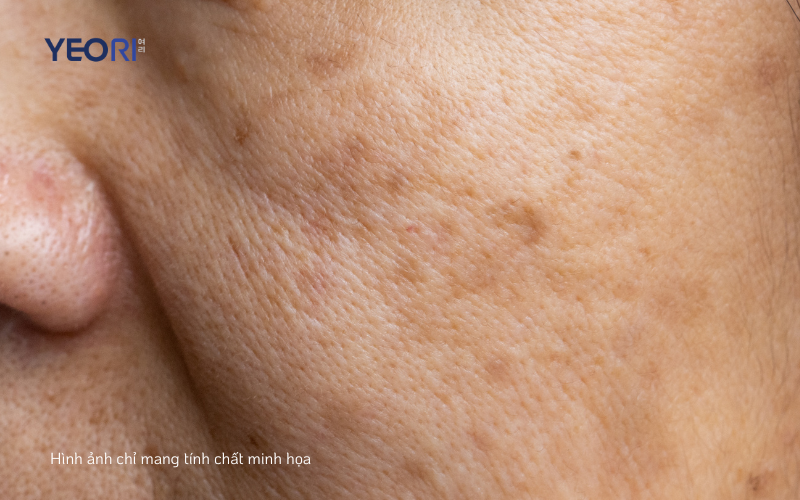 NÁM CHÂN SÂU VÀ NÁM MẢNG: PHÂN BIỆT THẾ NÀO VÀ PHÁC ĐỒ CẢI THIỆN RA SAO?